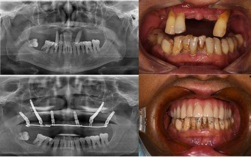 佛山种牙爆料事件视频最新,揭露行业乱象,患者权益谁来守护? 第3张 佛山种牙爆料事件视频最新,揭露行业乱象,患者权益谁来守护? 第3张